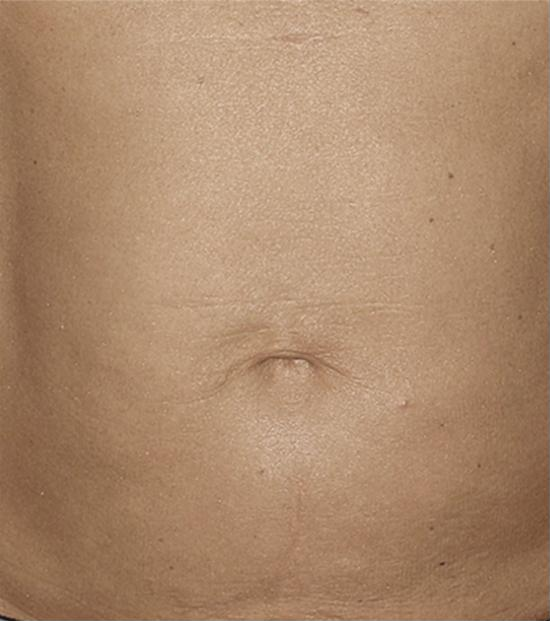 Thermage FLX body treatment – after
