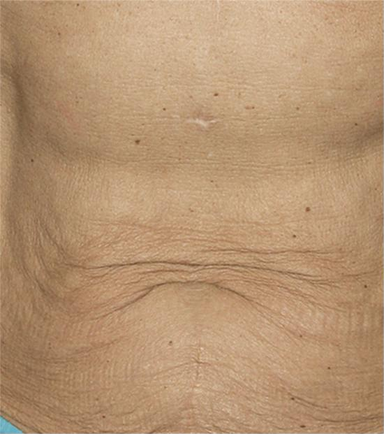 Thermage FLX body treatment – before