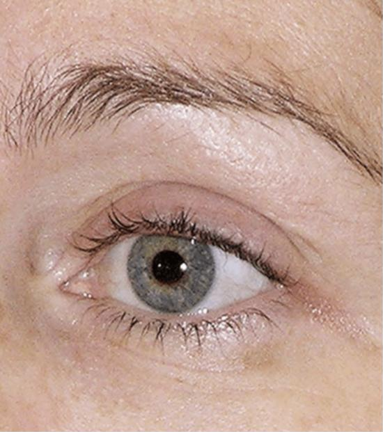Thermage FLX eye treatment – after