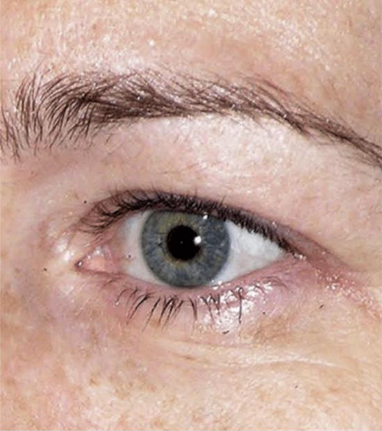 Thermage FLX eye treatment – before