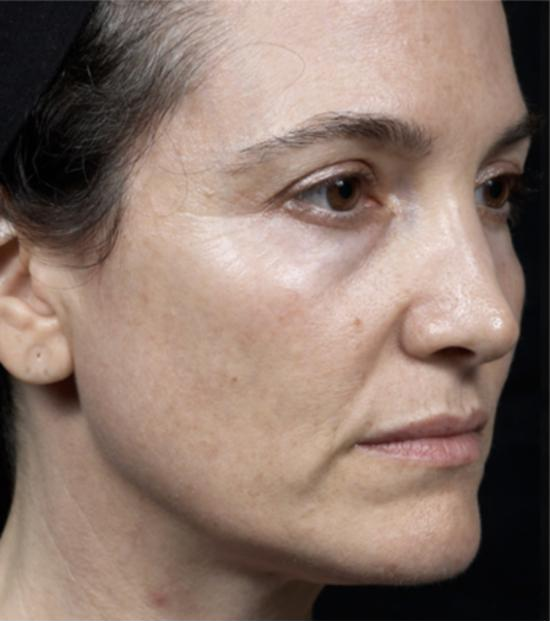 Thermage FLX face treatment – after