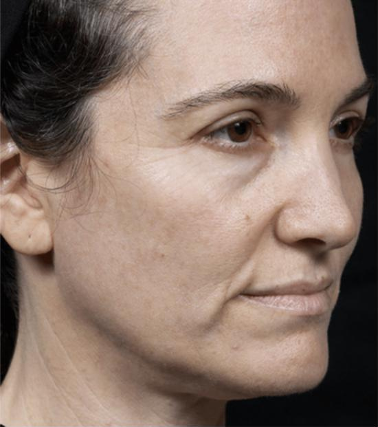 Thermage FLX face treatment – before